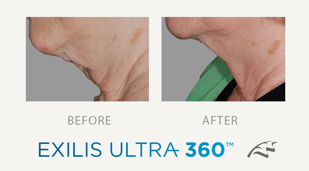 exilis ultra 360 before & After Jowels